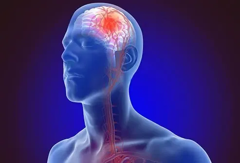 brain stroke